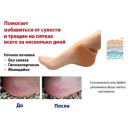 Силіконовий фіксатор для п'ят EL-1115 Heel anti-crack sets Бандаж проти натирання п'ят (5652) Силіконовий фіксатор для п'ят EL-1115 Heel anti-crack sets Бандаж проти натирання п'ят (5652)